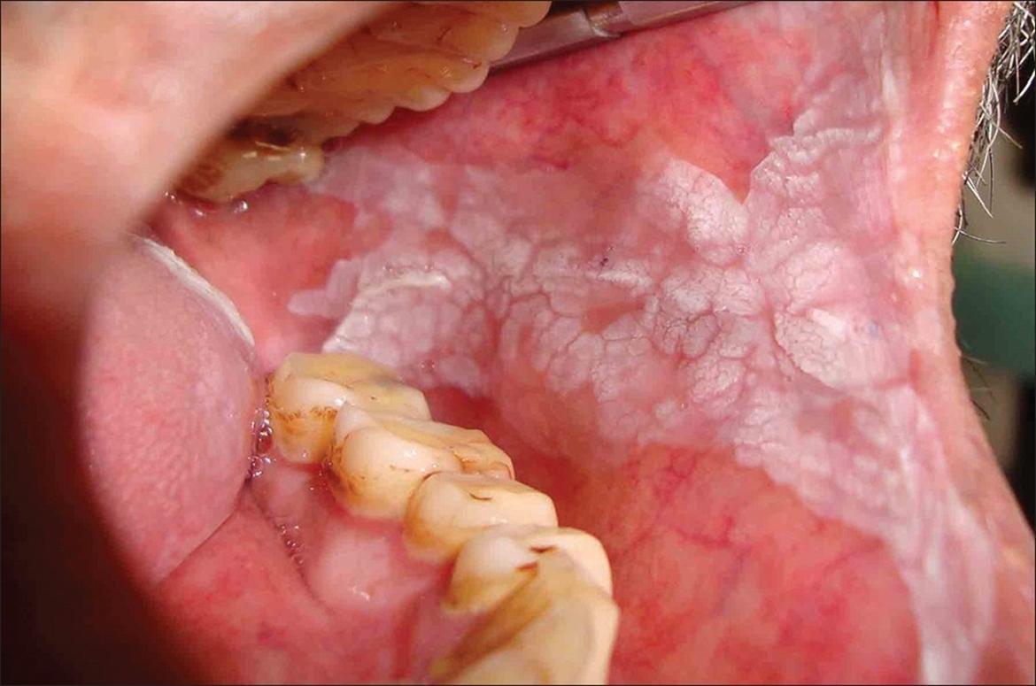 白喉（diphtheria）症状和详情