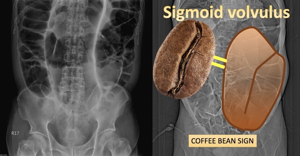 七旬老翁腹脹一週未排便 腹痛就醫竟是大腸打結險喪命