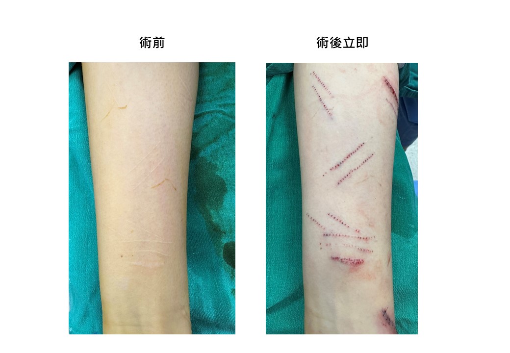 英國籍港妹雙手刀疤累累長達50公分創紀錄  來台求治白疤之父曹賜斌獲重生