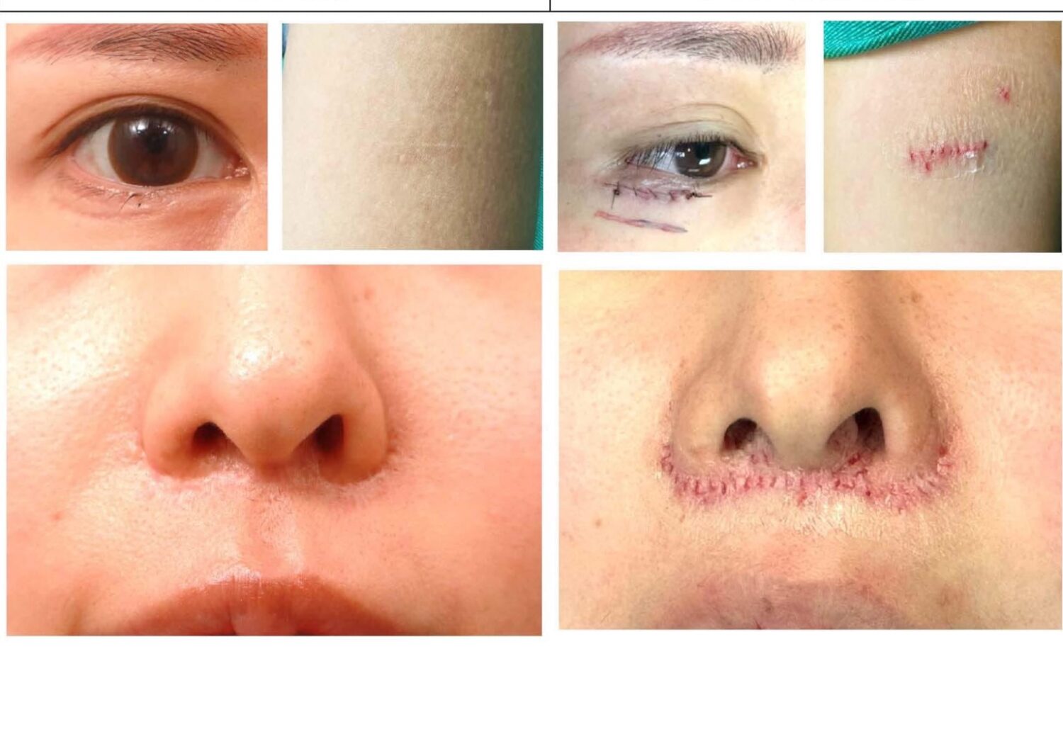 日本男女白疤患者相繼來台醫治 白疤之父曹賜斌醫師「神救援」