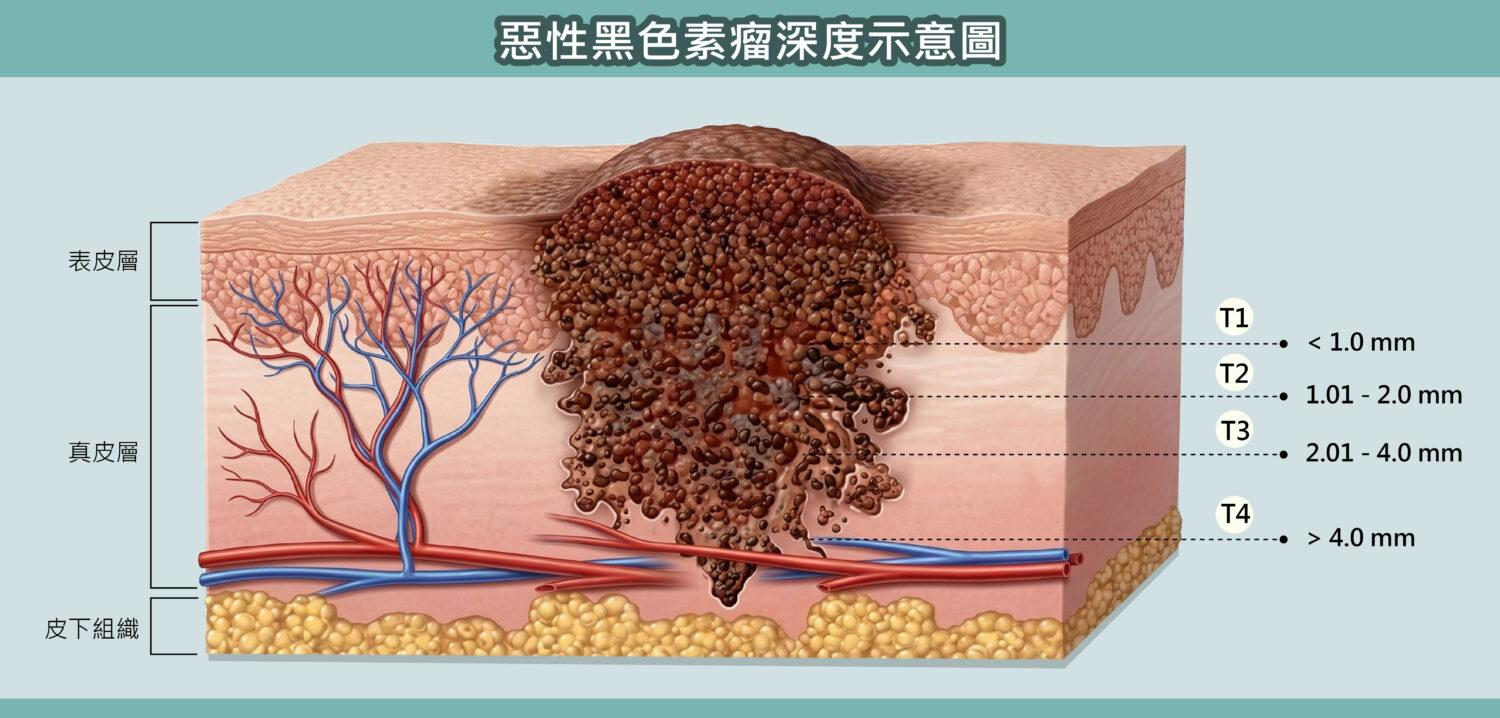 誤以為是甲溝炎竟查出「皮膚癌之冠」！ 高醫整外精準揪出「惡性黑色素瘤」 跨團隊守護化解致命危機