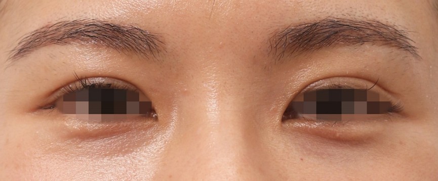 不當點痣毀容事件頻傳 曹賜斌醫師利用高頻電波新療法成解方